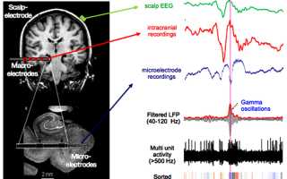 Что означают диффузные изменения биоэлектрической активности головного мозга легкой степени