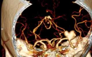 Возможности и ограничения мультиспиральной компьютерной томографии коронарных артерий для неинвазивной диагностики ИБС