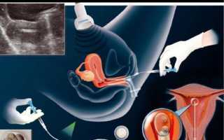 УЗИ после переноса эмбрионов, появление сердцебиения