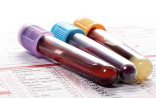 Как в лаборатории определяют MID в общем анализе крови и какие показатели нормы