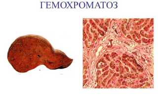 Гемохроматоз