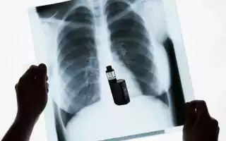 Рентген легких: при курении, нарушении бронхиальной проходимости
