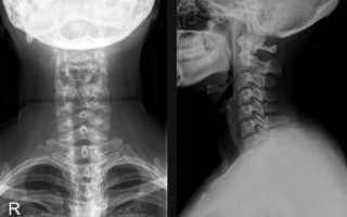 Что такое рентген с функциональными пробами шейного отдела
