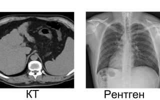 Выявление патологий на рентгене легких: что лучше КТ или рентген