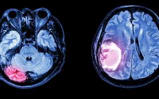 Перивентрикулярный глиоз в головном мозге: симптомы, причины, лечение