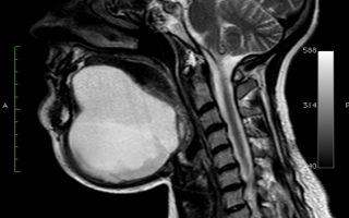 Что покажет МРТ при шейном остеохондрозе