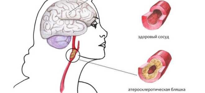 Дисциркуляторная энцефалопатия (ДЭП): развитие и диагноз, симптомы и стадии, терапия