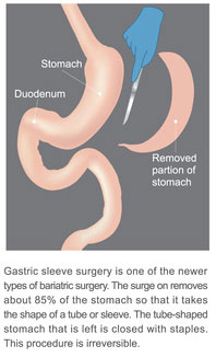 Sleeve gastrectomy
