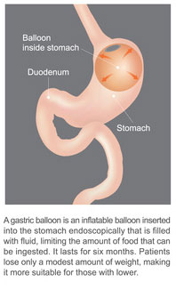 Gastric balloon